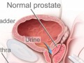 Some prostates are larger than others