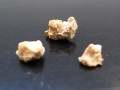 How to Treat Kidney Stones with Diet