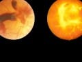 Can Diabetic Retinopathy Be Reversed?