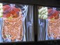 How to Become a Fecal Transplant Super Donor