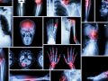 The Effects of Low-Level Lead Exposure in Adults