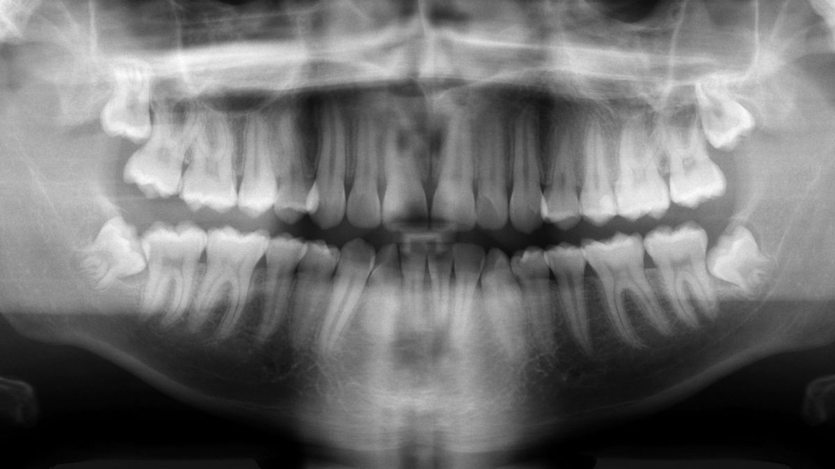 How to Treat Periodontal Disease with Diet