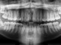 How to Treat Periodontal Disease with Diet