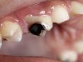 How to Stop Tooth Decay