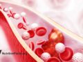 Cholesterol plaque in artery